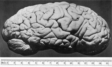 Black and white photograph of the right hemisphere of human brain with ruler measurement